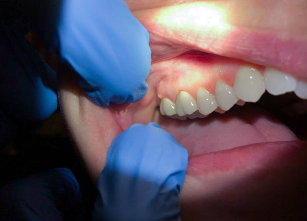 Best Emergency Tooth Extraction in Ladson, SC